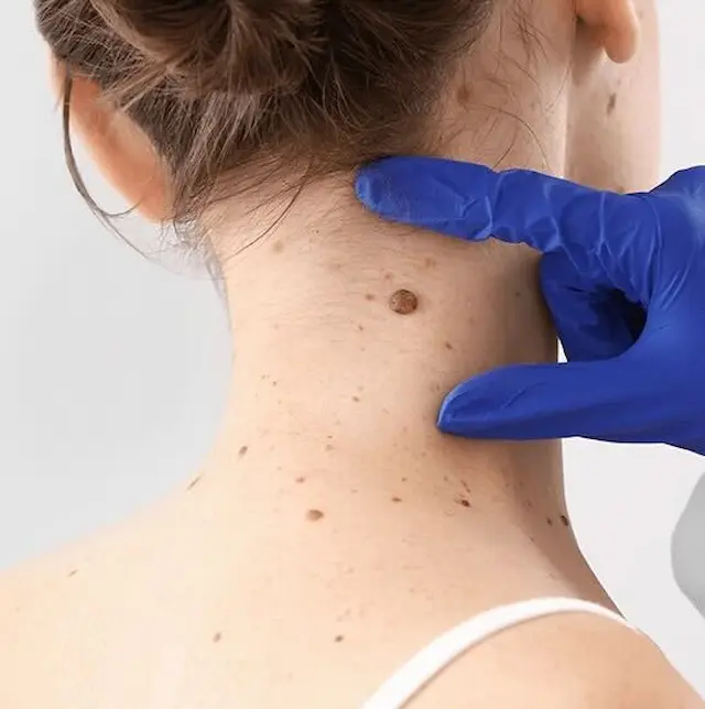 イボホクロ取り